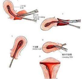 上环取环的相关要点,上环取环你了解多少呢