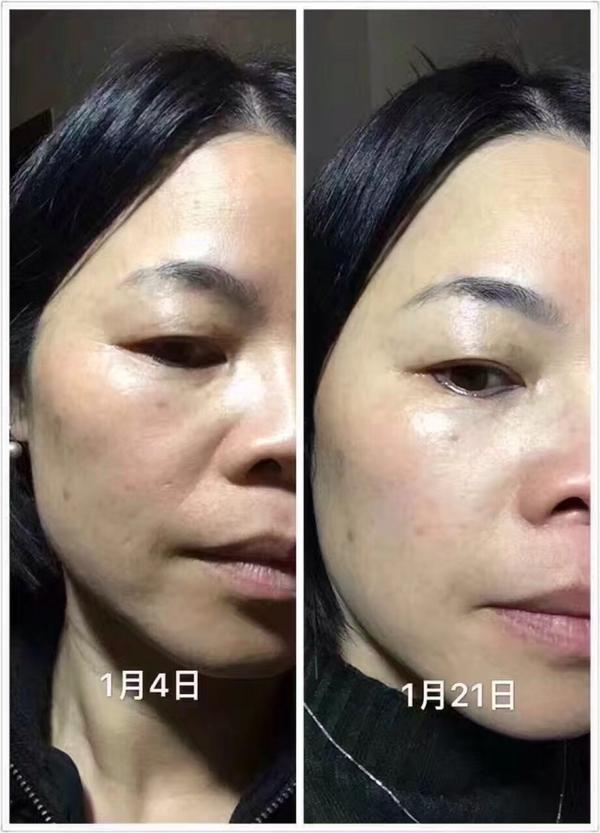 熊猫眼怎么祛除鱼尾纹,熊猫眼怎么去鱼尾纹