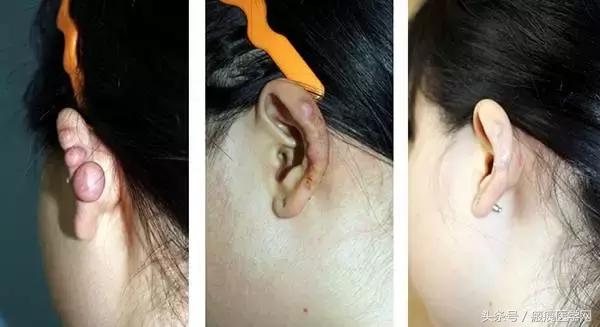 浅层放射治疗疤痕疙瘩,浅层x射线治疗疤痕疙瘩费用