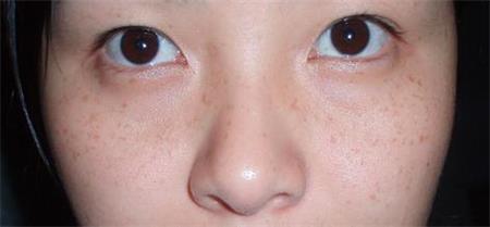 儿童雀斑遗传性怎么祛除,遗传性雀斑用药水去除会复发吗
