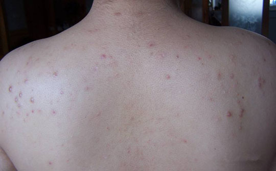 后背长痘怎么治疗最好的方法,青少年脸上和后背长痘怎么解决