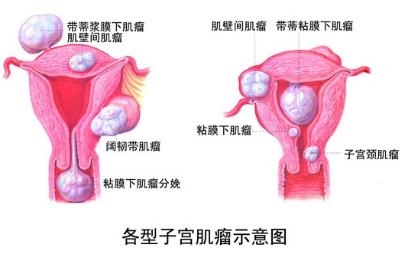 子宫上长了个包?别笑,三分之一的女性都会长!