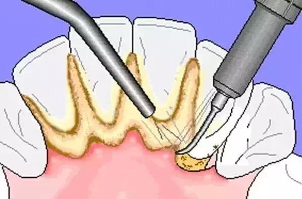 拥有一口好牙才能算的上完美，终极美白牙齿的攻略在这里！