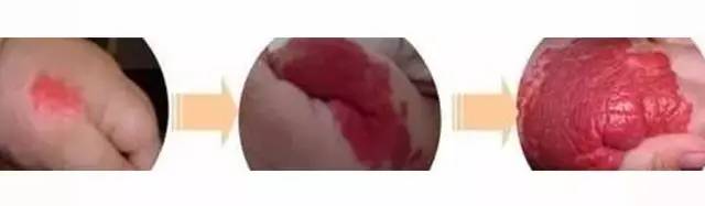 初生婴儿痣和胎记怎么区别,孩子长痣和胎记区别