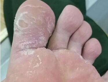 脚底脱皮什么原因怎么治疗,脚底脱皮是什么原因不痒不臭