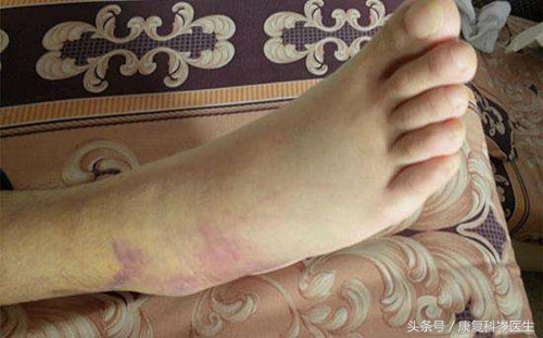 跑步踝关节拉伤怎么恢复,跑步脚踝扭伤已经4年了怎么恢复