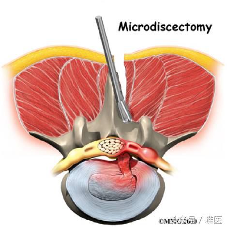 不小心把腰扭了怎么快速修复,不小心把腰扭了不太严重怎么处理
