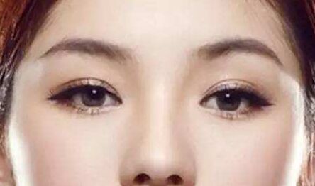 做眼袋后下眼睑外翻有办法解决吗,眼睑外翻怎么办