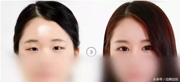 大小眼如何改善,青少年大小眼怎么改善