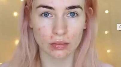 看皮肤科痘痘要问医生什么问题,脸上生疮发红和有硬块怎么治