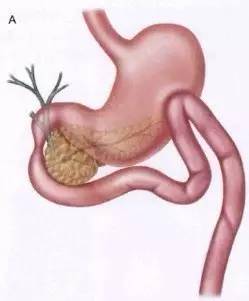 胃镜预处理流程,胃镜内镜手术全流程