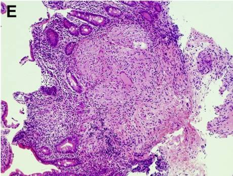 腹泻的不同类型及病例,腹泻的不同原因及现象