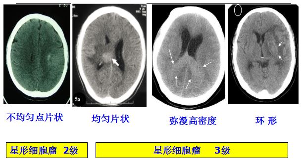 医学干货：瘤样炎性脱髓鞘病与胶质瘤、PCNSL临床、影像鉴别