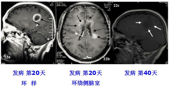 医学干货：瘤样炎性脱髓鞘病与胶质瘤、PCNSL临床、影像鉴别
