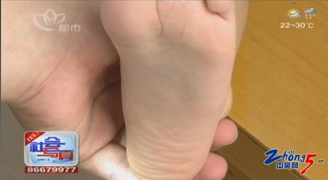 手足口病高发图片,手足口病发病率