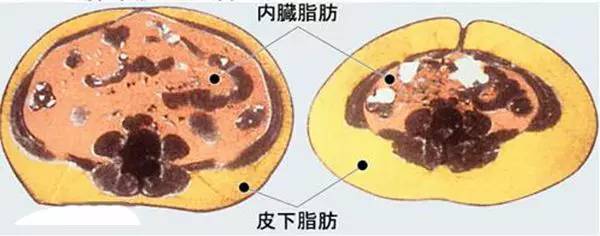肥胖人的内脂,是虚胖好减还是真胖好减