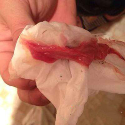 产后60多天了恶露反复,小产后恶露反复排不干净怎么办