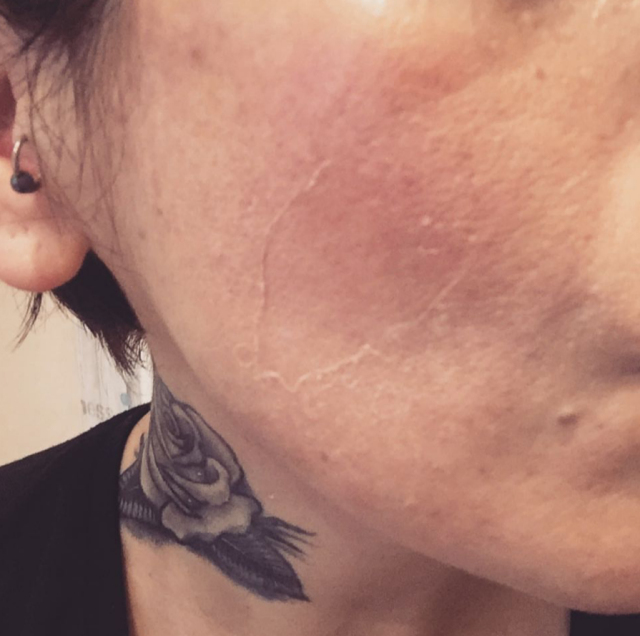 怎样才能祛痘去黑头去闭口,祛痘去黑头粉刺闭口