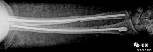 肱骨髓内钉的手术体位,肱骨髓内钉术后康复恢复步骤