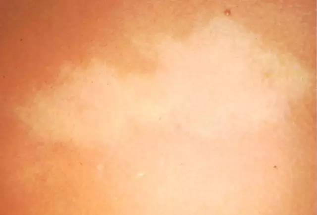 宝宝身上很多痣,宝宝身上的痣有母痣