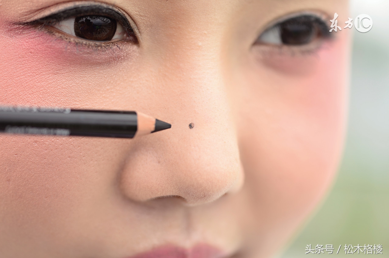 有痣青年要注意这几种痣易恶变,痣长成了大痣可以点掉吗