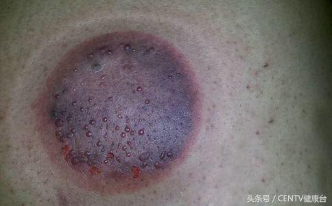 推完背拔完罐后背黑紫是什么原因,拔空气罐后皮肤黑紫原因