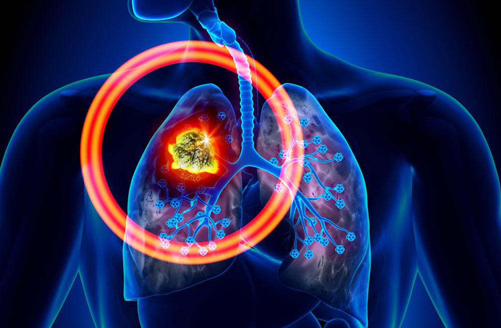 不吸烟的人更容易患肺癌,为什么不吸烟也能患肺癌