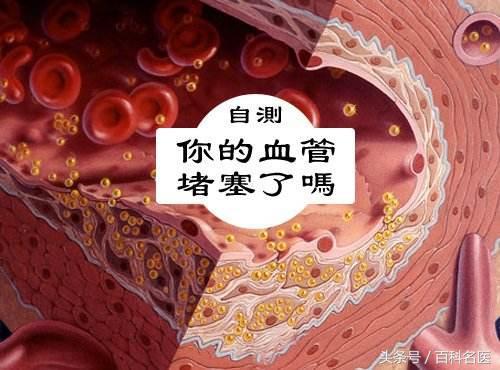 吃什么食物可以预防心脑血管堵塞,十大现象预示血管已堵塞