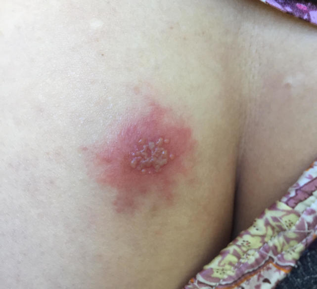 外阴长水泡破了很痛,外阴起水泡一定是生殖器疱疹吗