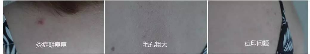 背上痘痘夏天怎么穿吊带,背后长痘痘怎么穿小吊带