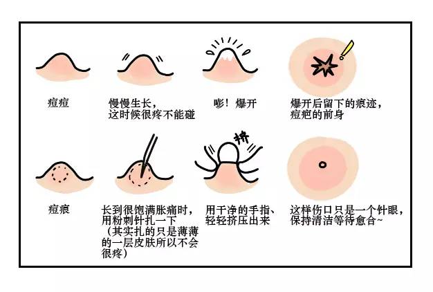 背上痘痘夏天怎么穿吊带,背后长痘痘怎么穿小吊带