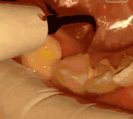 20年不洗牙,20年不刷牙还能刷白吗