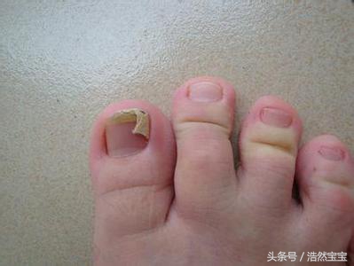 发现孩子指甲有问题日常建议,家长注意孩子手指甲