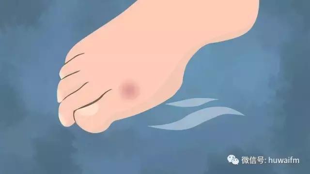 新鞋磨脚磨出水泡,新鞋磨脚破了怎么办