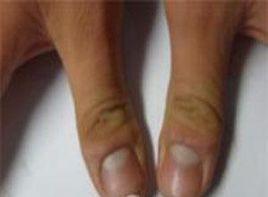 指甲里的黑线是什么物质,指甲若出现白点可能提示哪种情况