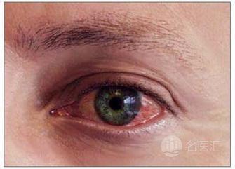 急性结膜炎儿童需尽快就医吗,急性角结膜炎的症状及治疗