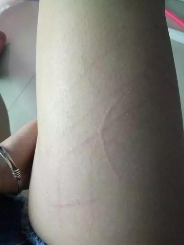 被猫狗咬伤没出血,被狗咬出血了一定要打狂犬疫苗吗