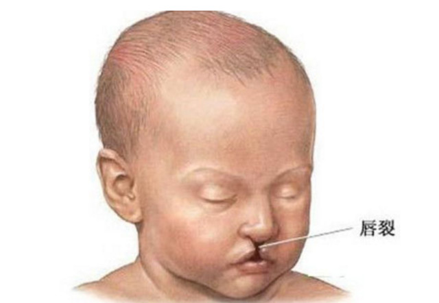 唇腭裂和兔唇四维提示什么,b超显示胎儿偏大一周会提前生吗