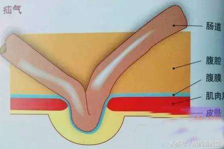 猪脐疝怎么治疗最有效的方法,猪脐疝引起的原因和处理方法