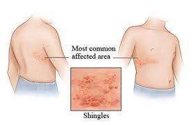 皮疹常见状态,各种皮疹的症状及区别
