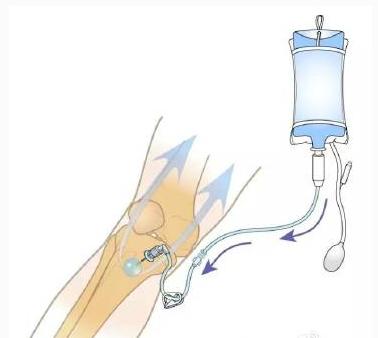 血液病红细胞增多,血液病红细胞增多症能治好吗