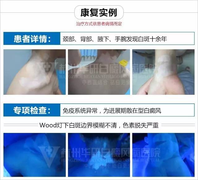白癜风有没自愈的病例,白癜风治愈一百例