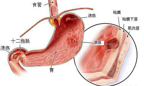 消化道疾病用什么药,消化道疾患常用中成药