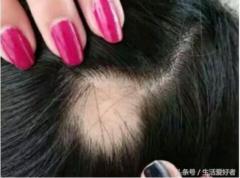 生发止脱发最快的方法,脱发剃光头用什么方法能生发