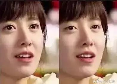 你的眼睛适合做什么手术,你的双眼皮什么时候做