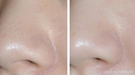 毛孔粗大要用什么办法收缩毛孔,毛孔粗大怎么办教你快速收缩毛孔