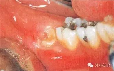 口腔拔牙图片,口腔拔牙麻醉多久消退