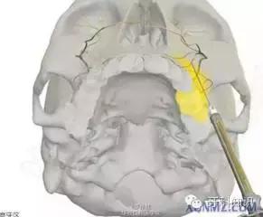 口腔拔牙图片,口腔拔牙麻醉多久消退