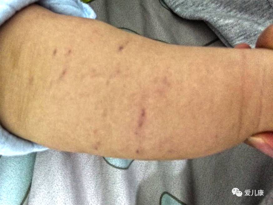 宝宝身上出现青紫怎么回事,宝宝皮肤青紫怎么好得快