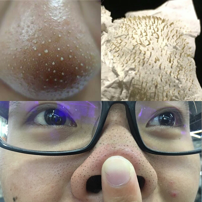 全面解析粉刺解决方法大全,教你几招认识痘痘才能真正根治